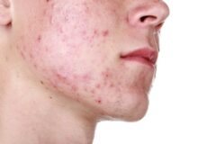 Acne-on-the-face
